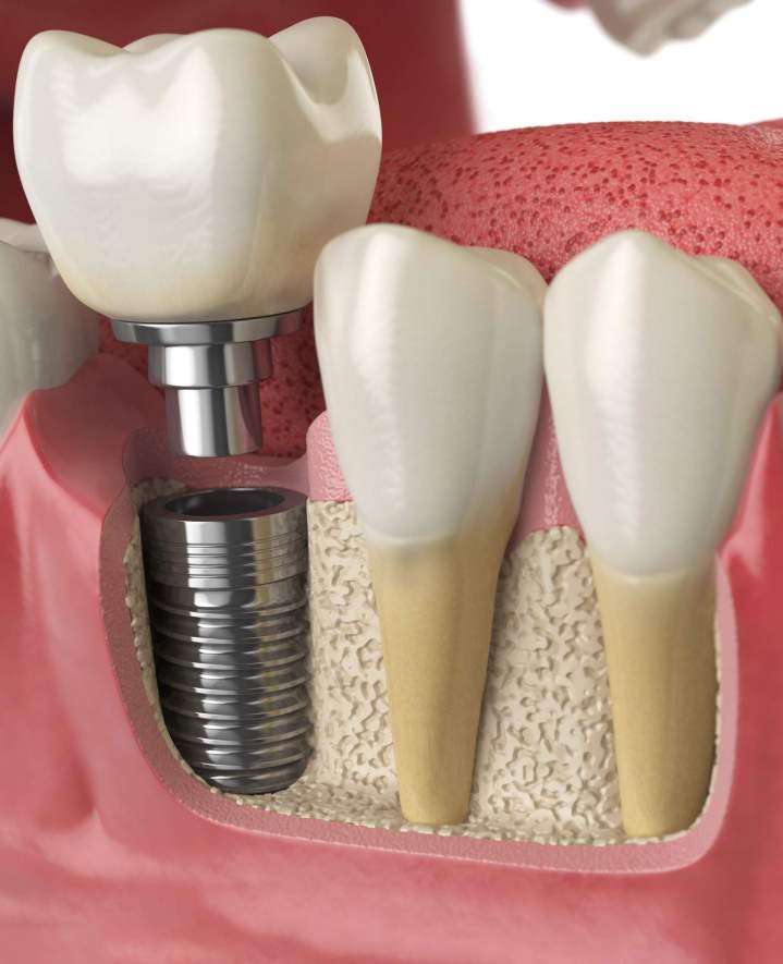 Dental prosthesis fitting in Boisbriand