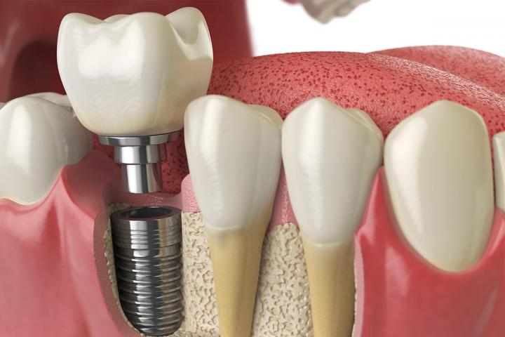 The place to be for implant-supported dentures.